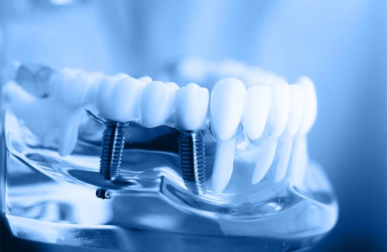 dental implants cta