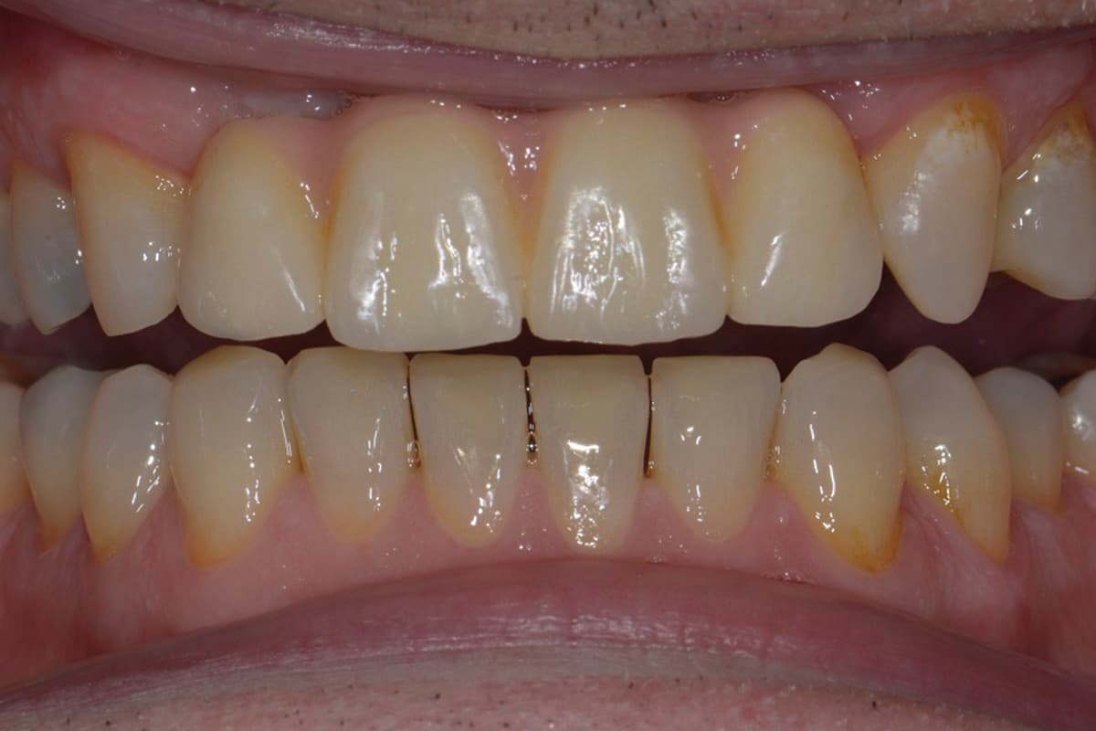 After Implant Bridge and Composite Bonding
