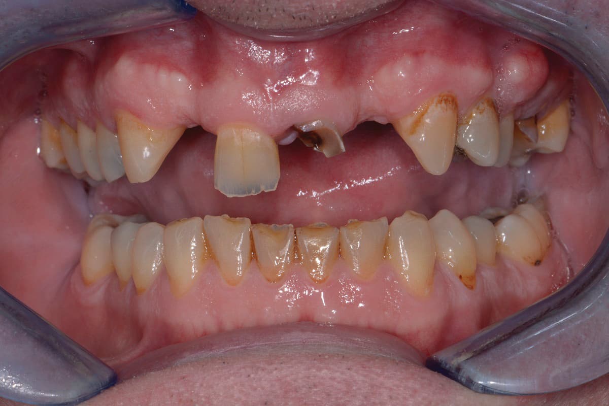 Before Implant Bridge and Composite Bonding