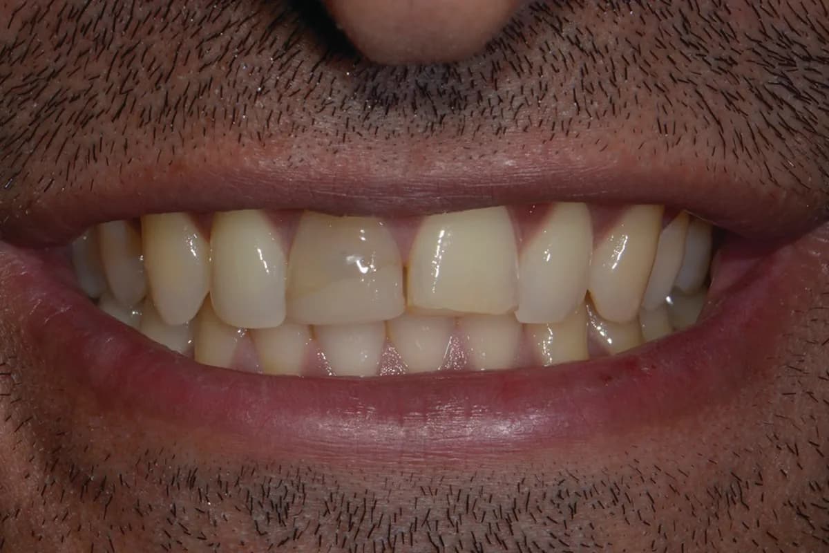 Before Internal/External Bleaching and Composite Bonding