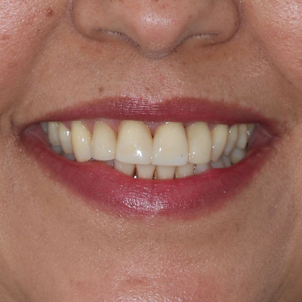 Straight, white teeth after using Invisalign clear braces & Composite Bonding