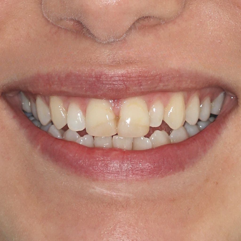A lady with chipped, yellow teeth before having composite bonding