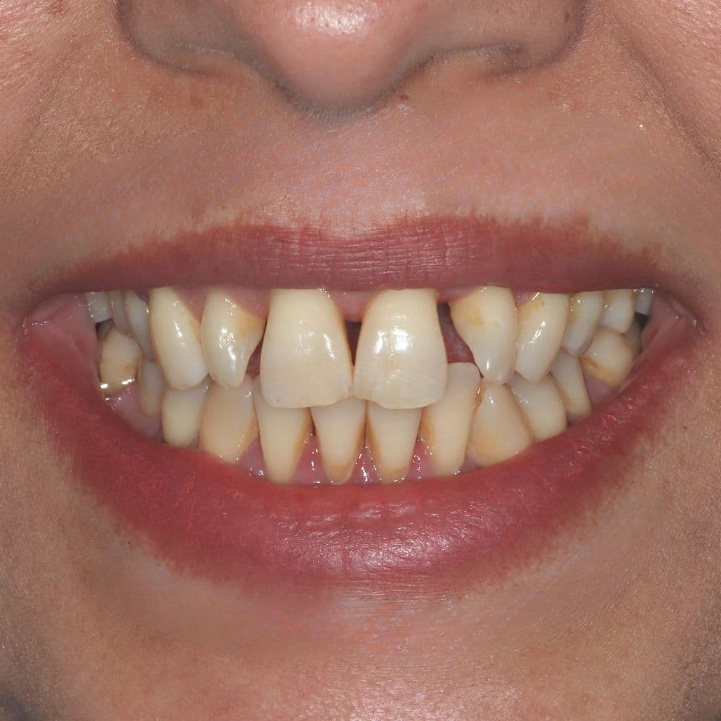 An Image of A woman before having lifechanging Invisalign treatment