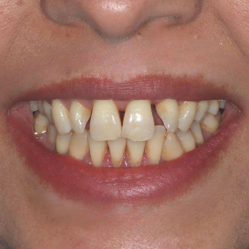 An Image of A woman before having lifechanging Invisalign treatment