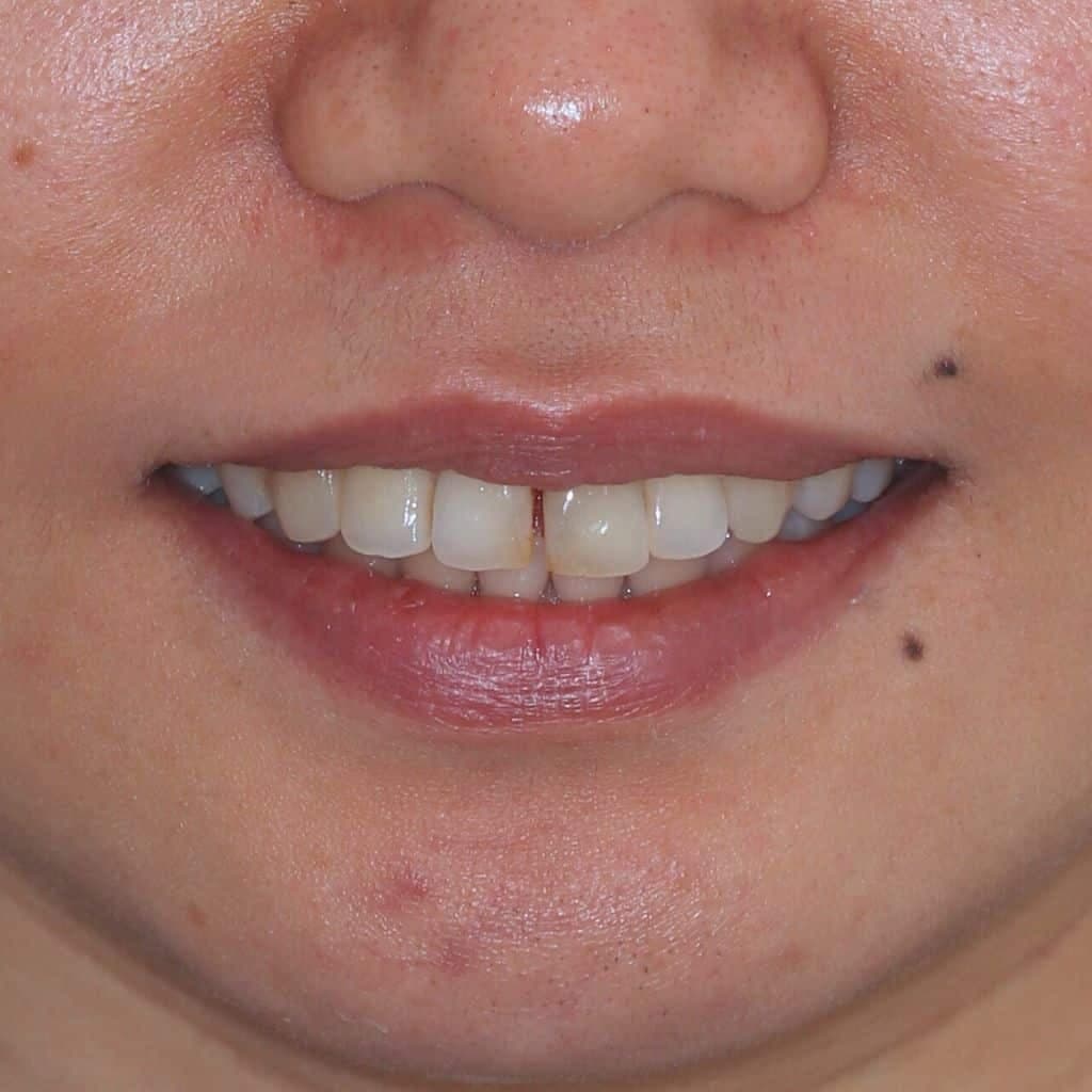 Someone with a gap between their front teeth
