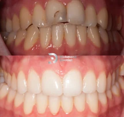 Close up of teeth before composite bonding with visible chips, discolouration, and damage (top), and after treatment with a clean, white, and even smile (bottom) by The Richmond Dentist.