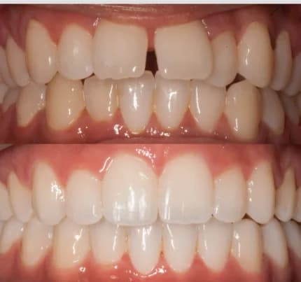 Close up comparison of teeth before Invisalign treatment with visible gaps and crooked alignment (top), and after treatment with perfectly aligned, straight teeth (bottom).