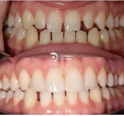 Close up comparison of teeth before orthodontic treatment with noticeable gaps and crooked teeth (top) and after treatment showing straight, well aligned teeth (bottom) with the The Richmond Dentist logo.