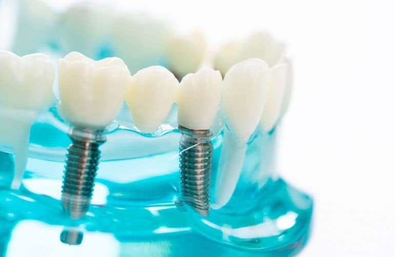 implant 770x500