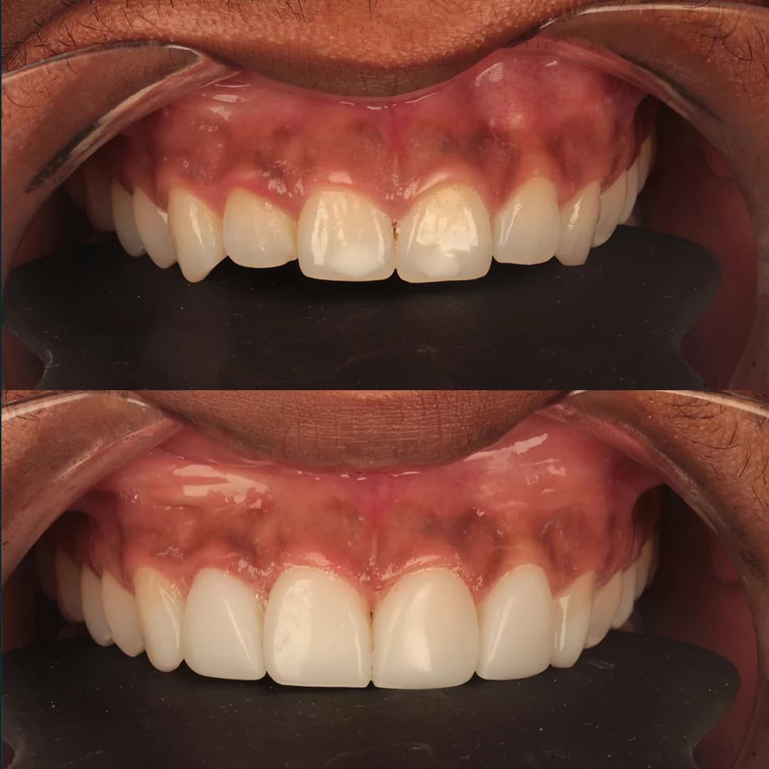 Teeth Whitening in Salford Quays, Manchester