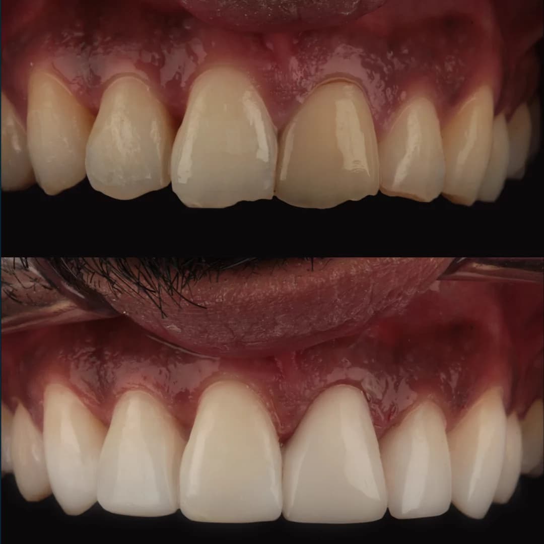 Invisalign Braces in Salford Quays, Manchester