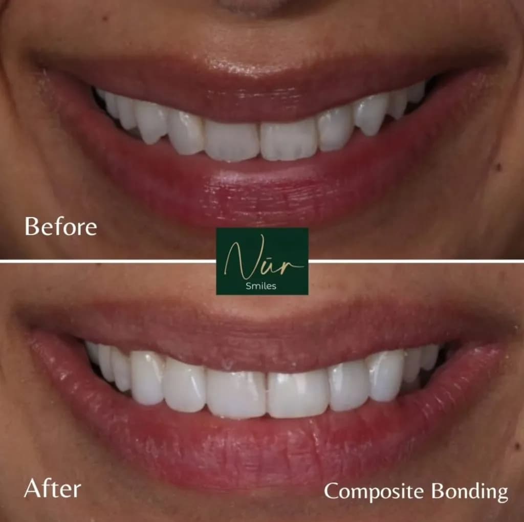 Smiling patient after successful cosmetic dental treatment at Nur Smiles Northwood