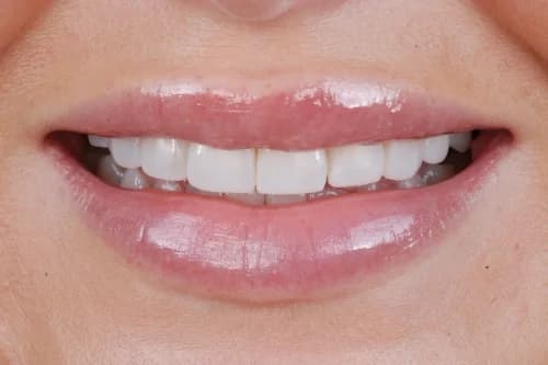 Invisalign enhance package Case 1 after