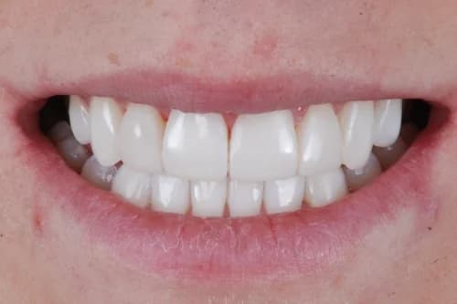 Invisalign enhance package Case 2 after