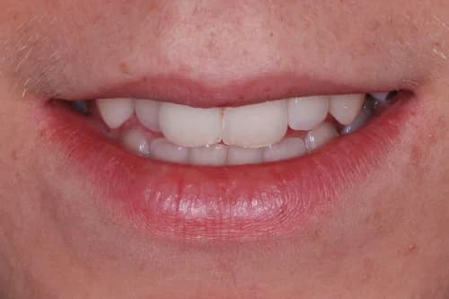 Invisalign enhance package Case 2 before