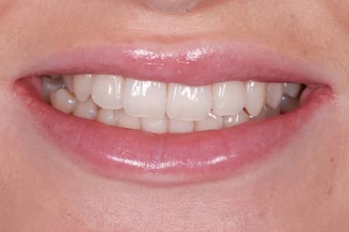 Invisalign enhance package Case 1 before