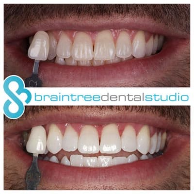 65e8e3321b824c4740d9e967 whitening 3