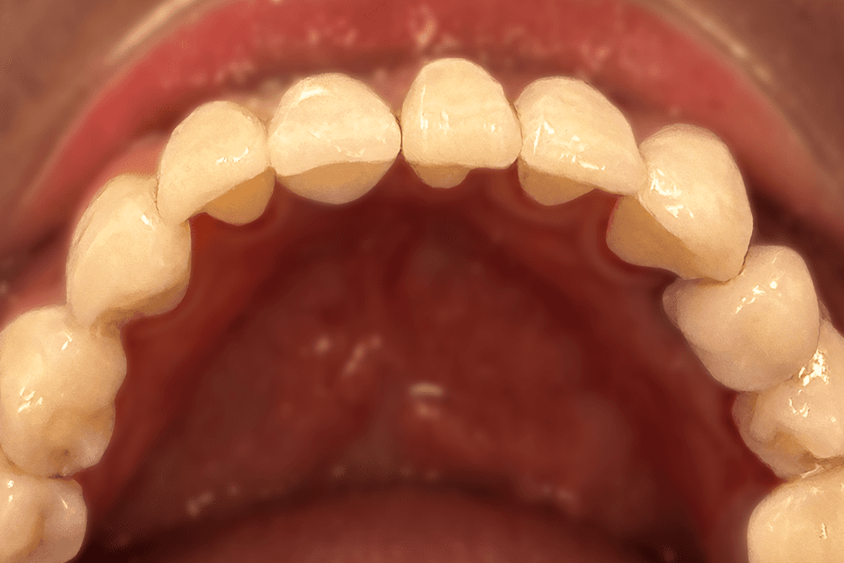 Implant 879 1