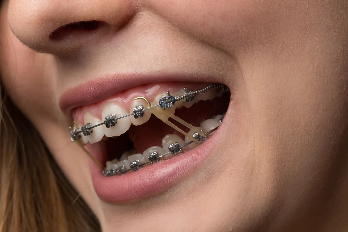 Close up of a patient wearing fixed metal braces and elastics fitted by a specialist orthodontist.