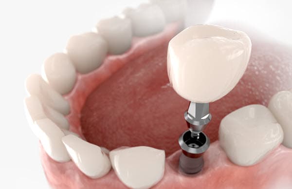 y bont faen dental implants