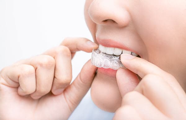 y bont faen invisalign 2