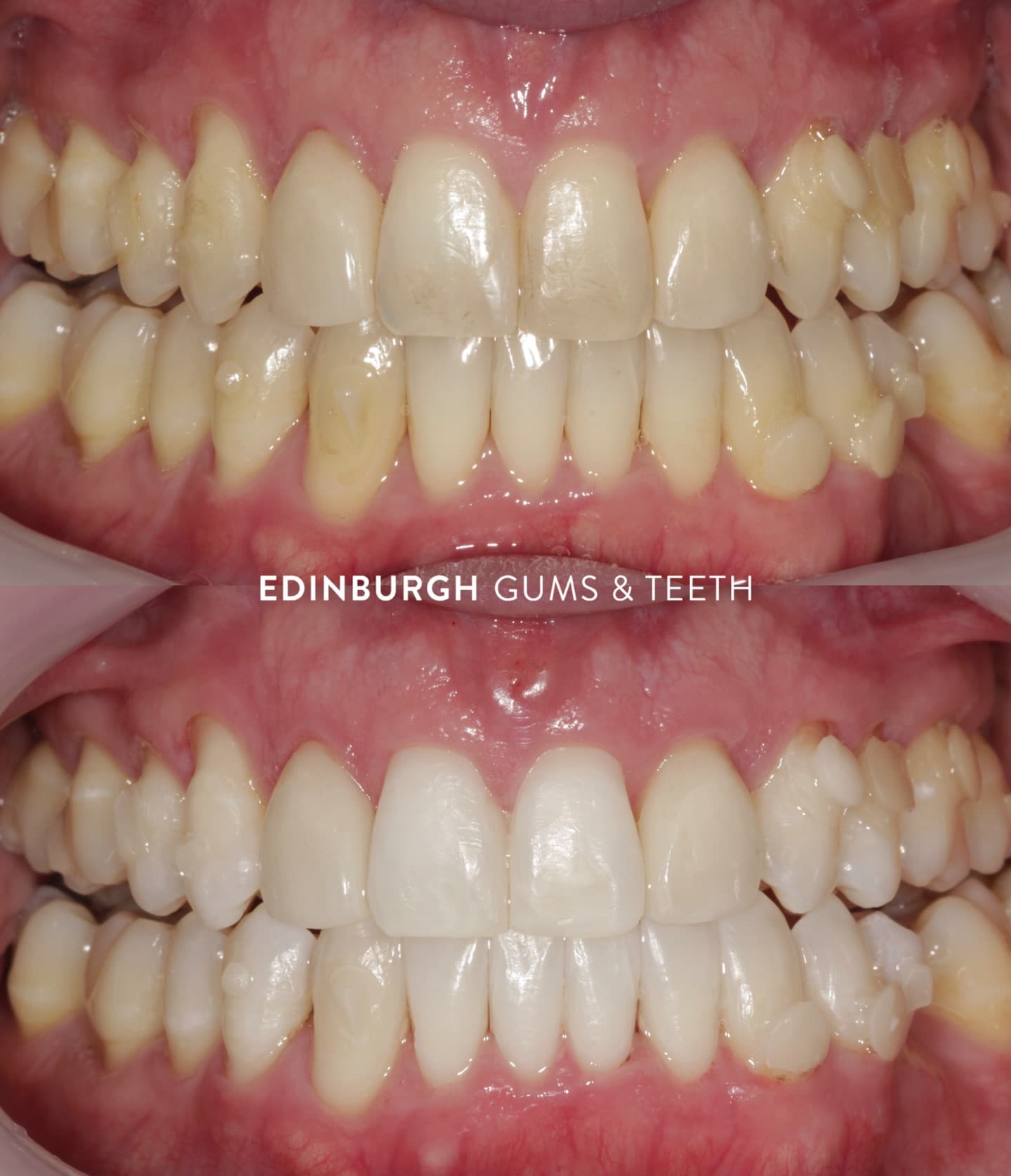 This patient is almost at the end of their Invisalign journey and decided to upgrade to our Philips Zoom in chair whitening here at the practice. Safe, fast and with amazing results. ✨ #edinburghgumsandteeth