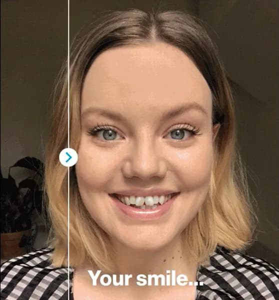 invisalign smile cropped